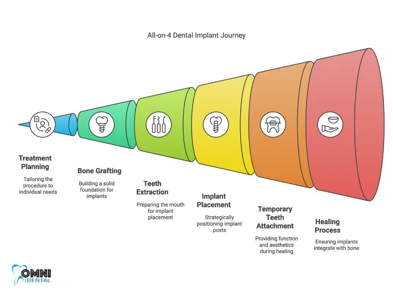 The All-on-4 Dental Implant Procedure: A Step-by-Step Guide