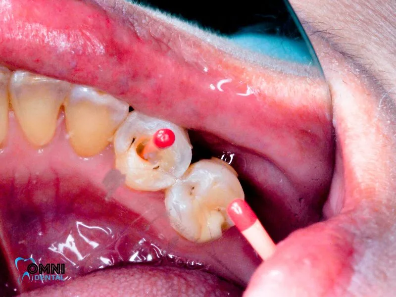 Why It’s Important to See Your Dentist Early