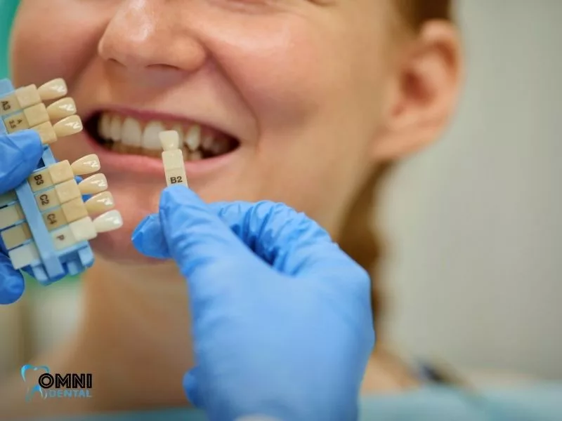 What are veneers