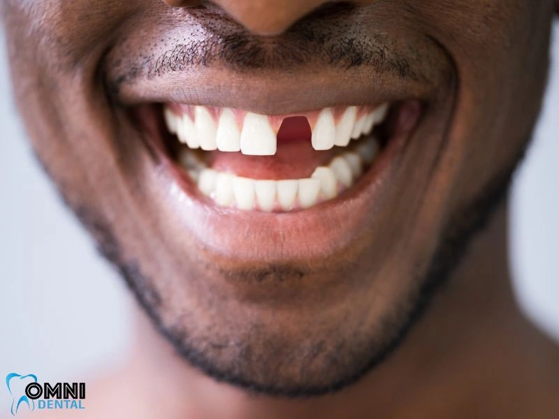 Aftercare for Front Tooth Implants