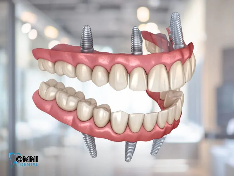 All-on-4 Implant Placement