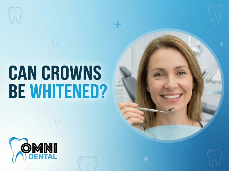 Can Crowns Be Whitened
