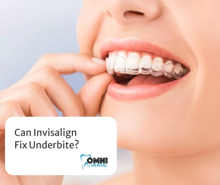 Can Invisalign Fix Underbite