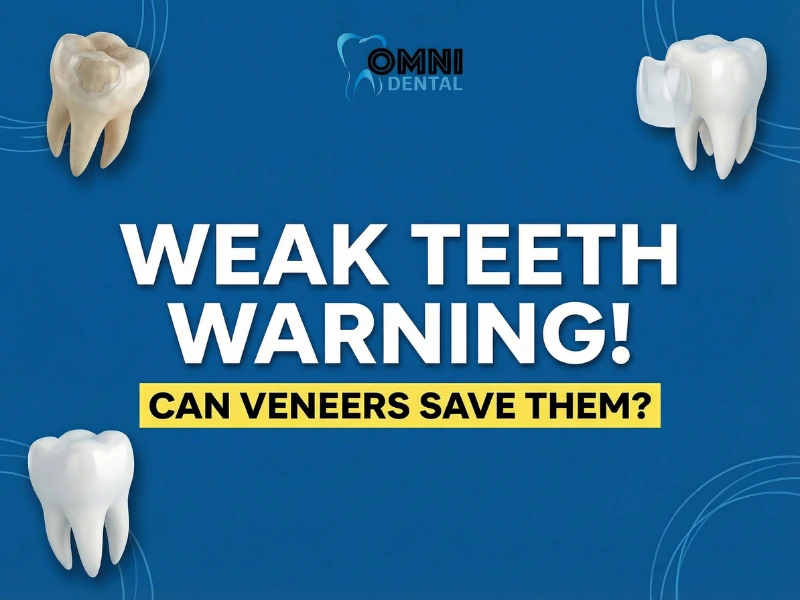 Can Veneers Protect Weakened Teeth