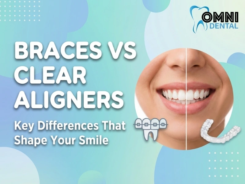 Choosing Between Braces and Clear Aligners