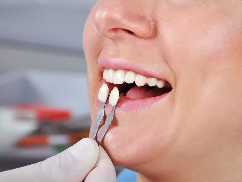 Tips for Caring for Your Temporary Crown Between Appointments