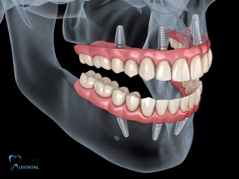 Can you put a temporary tooth while waiting for an implant?