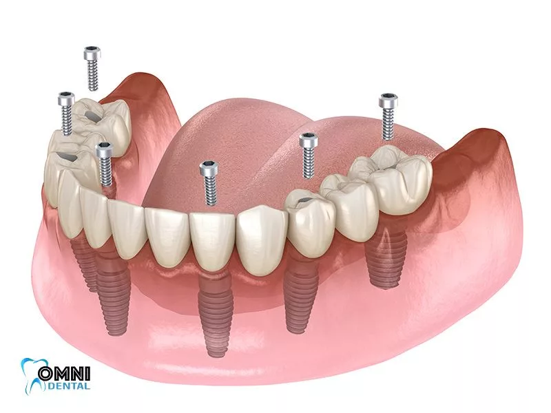 3D model of a full arch of replacement teeth fixed on dental implants