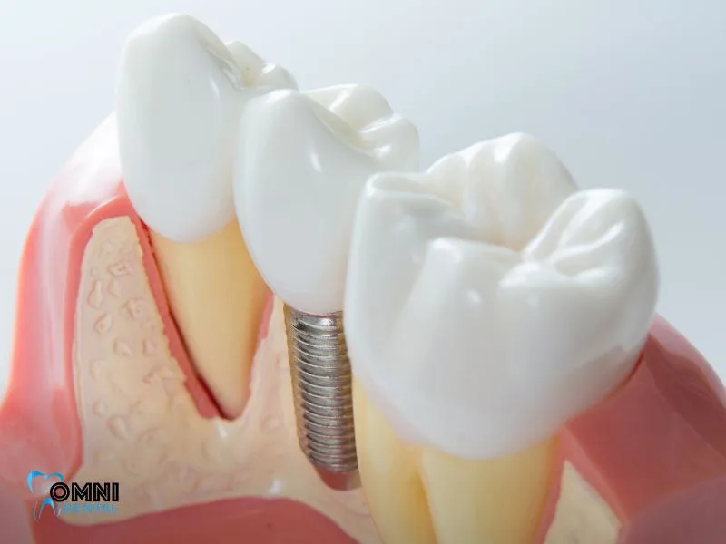 Benefits of Dental Implants