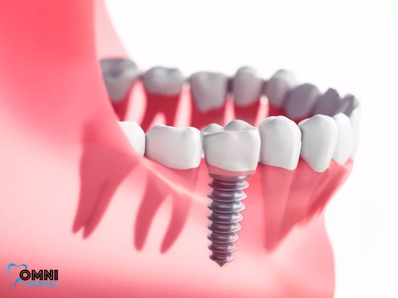 Dental Implant Technology