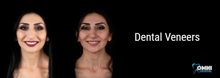 How Long Do Dental Veneers Last