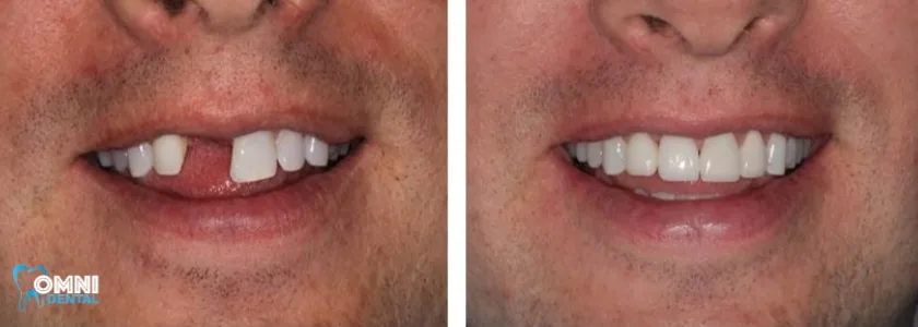 Front Tooth Replacement