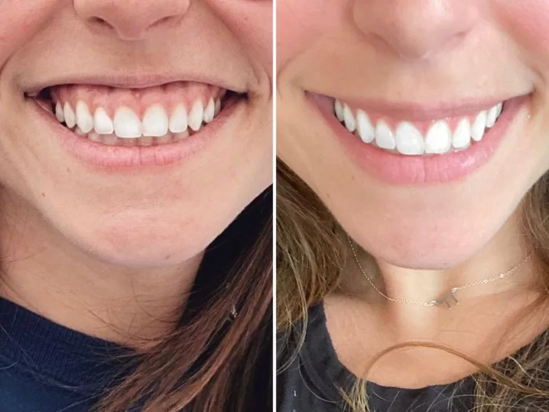 How to get rid of a Gummy Smile