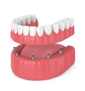 Implant-Retained Denture Cost