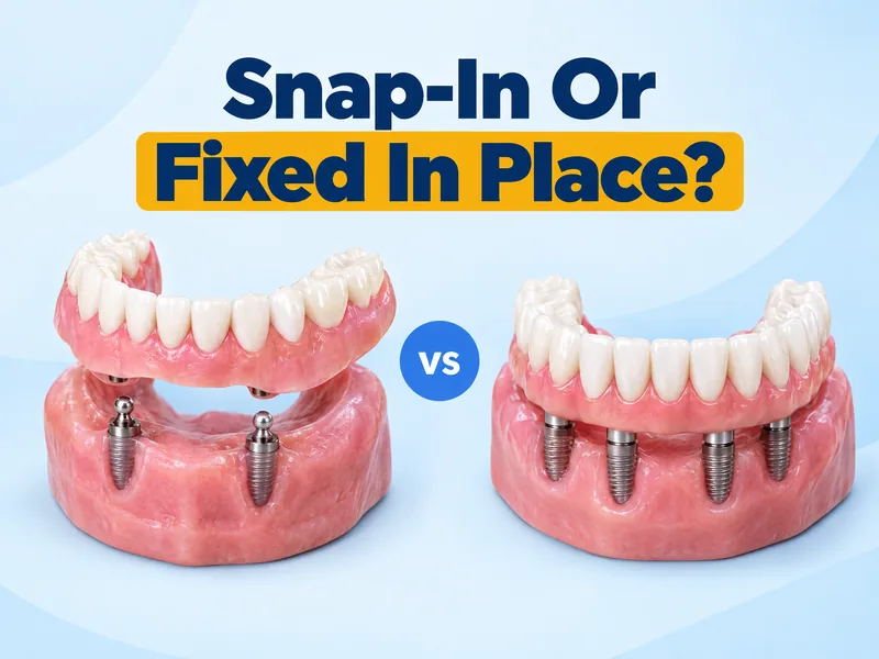 Implant supported vs implant retained dentures headline image with two denture renders and a vs chip