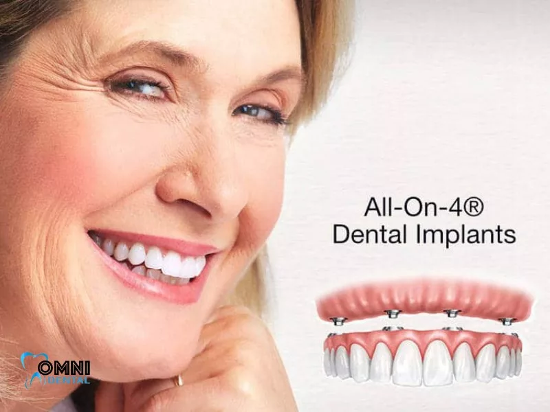 All-on-Four Dental Implants Step by Step