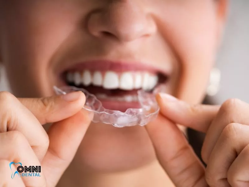 3 Reasons to Consider Clear Braces