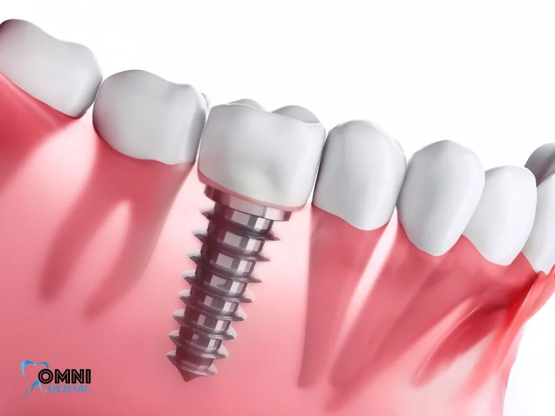 Can Implants With Gum Disease Be Successful?