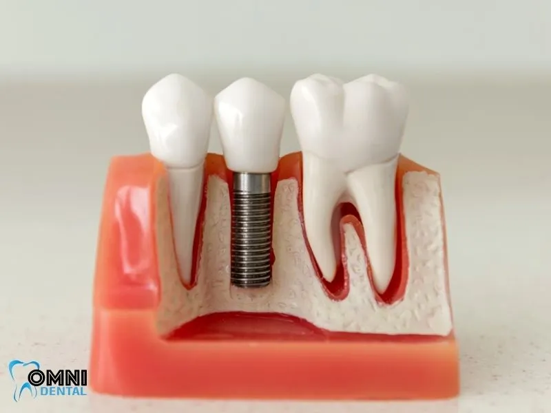 Routine Checkups for Dental Implants