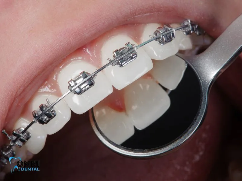 How to Fix a Misaligned Bite with Orthodontics