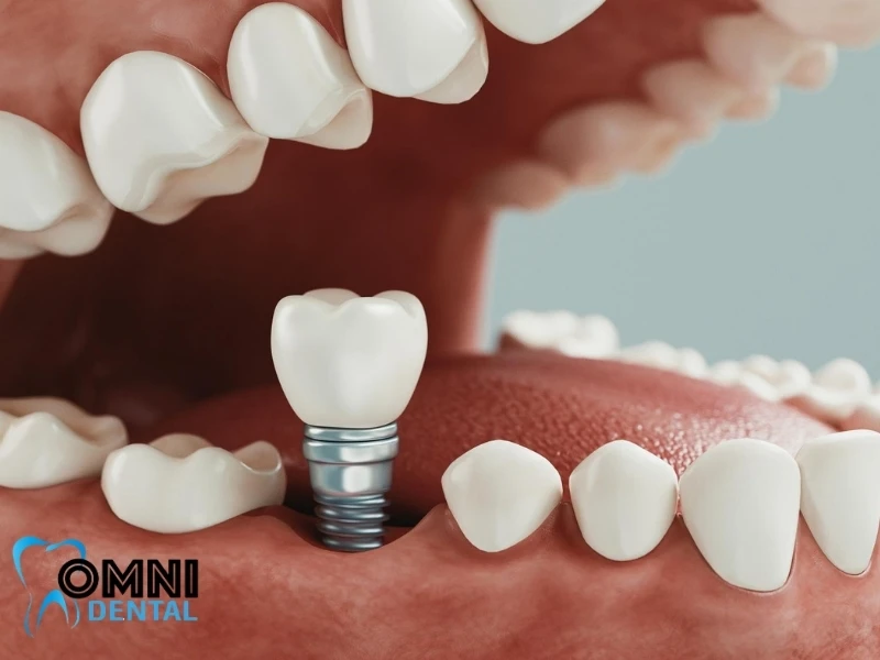 Poor Oral Hygiene