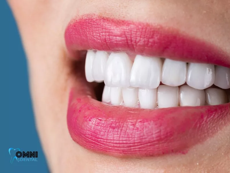 Can You Whiten Porcelain Veneers?