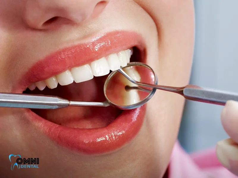 How Dental Issues Begin and Escalate