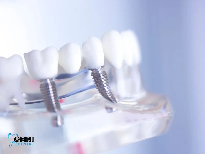Comprehensive Care Guide for All-on-4 Dental Implants