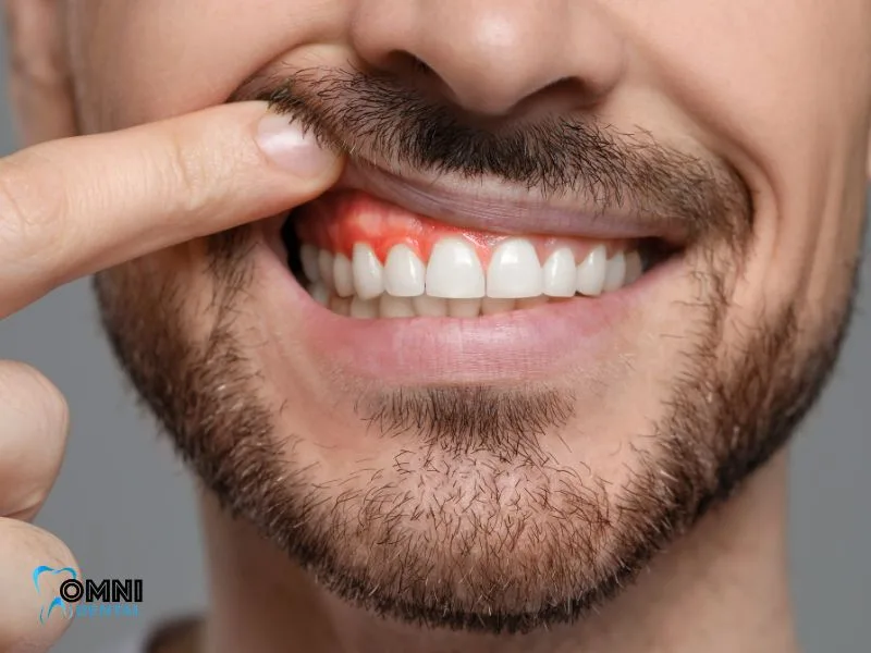 The Warning Signs of a Tooth Abscess You Shouldn’t Ignore