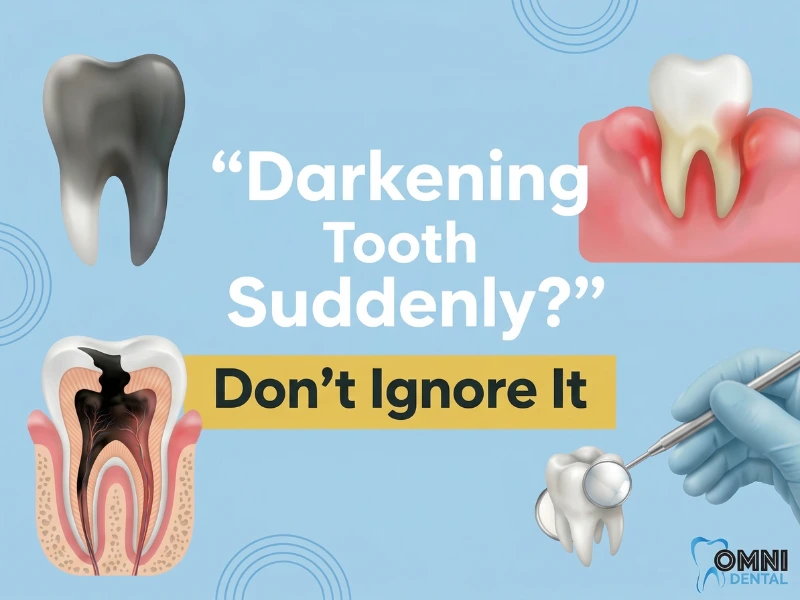 Top Signs You Need a Root Canal