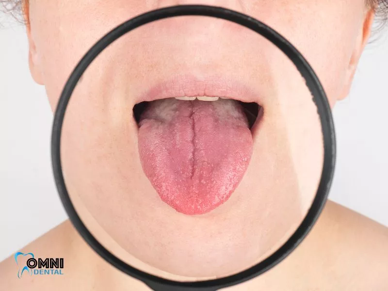 Understanding Oral Cancer
