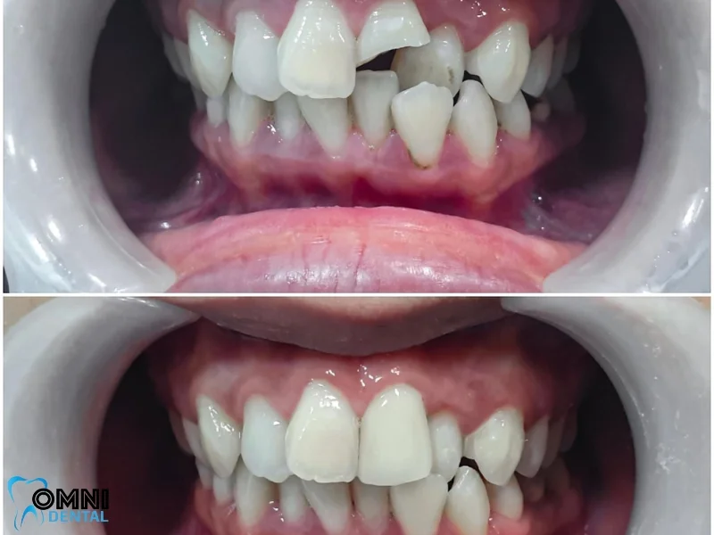 What Is a Front Tooth Implant