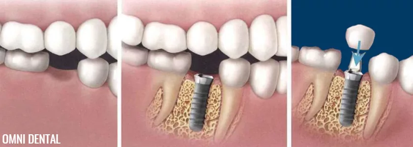 dental implant surgery