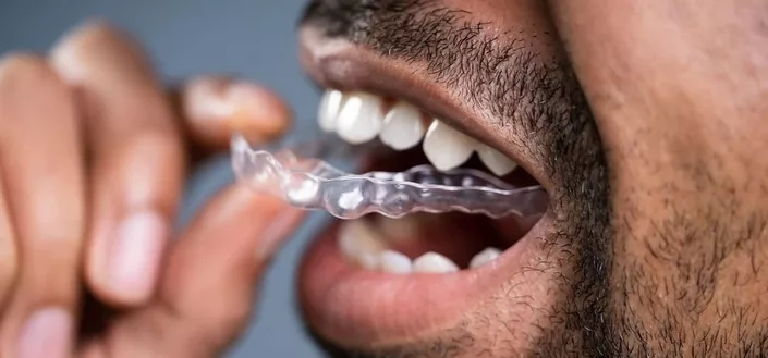 Who Can Benefit From Invisalign