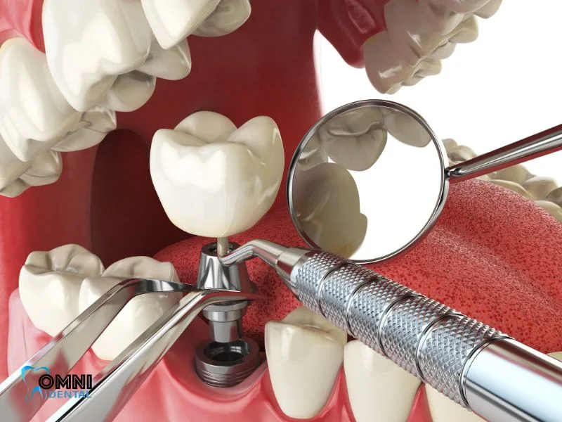 who is not suitable for dental implants