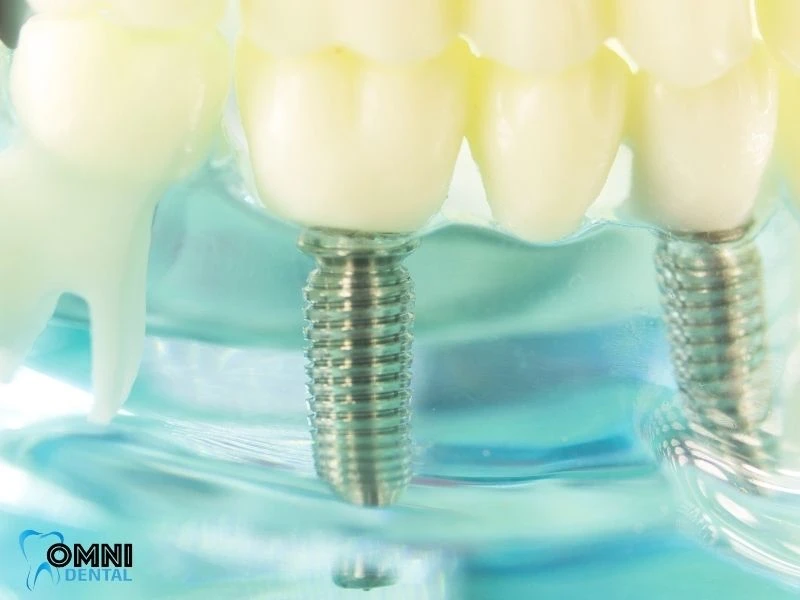 Why Titanium Implants Work So Well