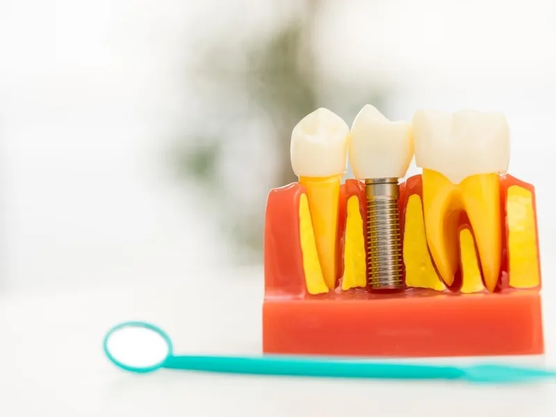 Why Tooth Loss Changes the Shape of Your Face