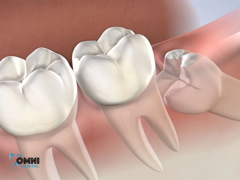 The Importance of Wisdom Tooth Removal