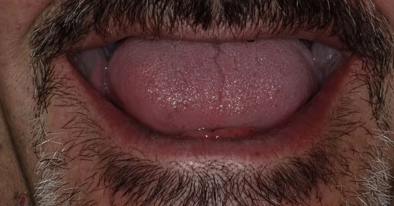 Before full arch restoration case 1: an Omni Dental patient's teeth before treatment