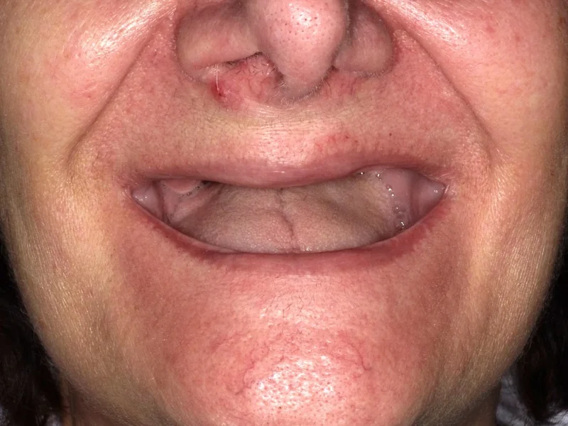 Before full arch restoration case 2: an Omni Dental patient's teeth before treatment