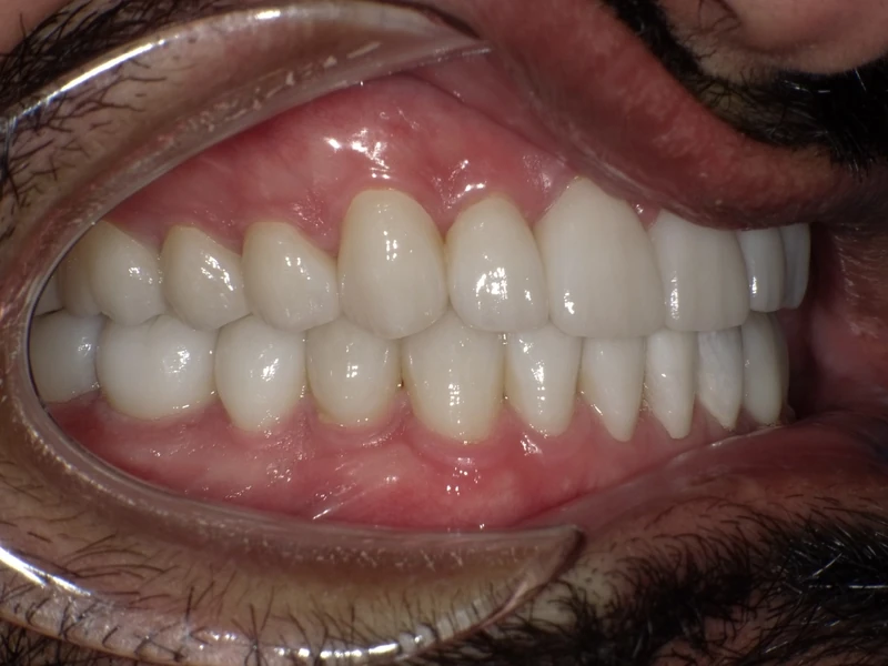 After full mouth restoration: the same patient's teeth after treatment at Omni Dental