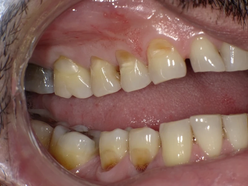 Before full mouth restoration: an Omni Dental patient's teeth before treatment