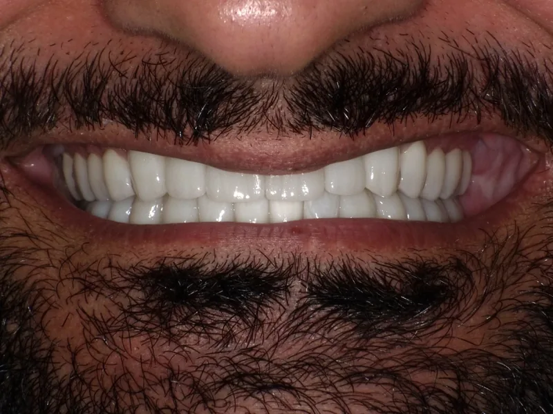 After smile restoration case 3: the same patient's teeth after treatment at Omni Dental
