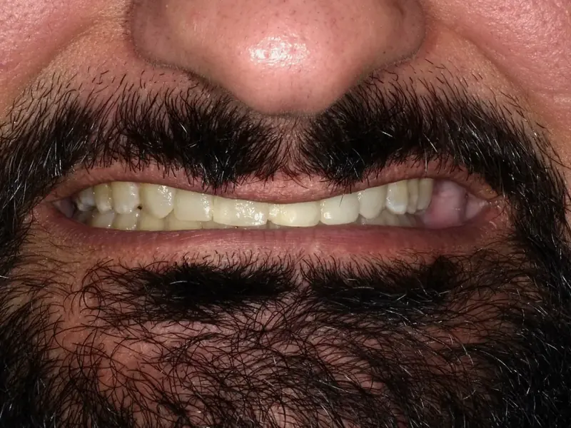 Before smile restoration case 3: an Omni Dental patient's teeth before treatment