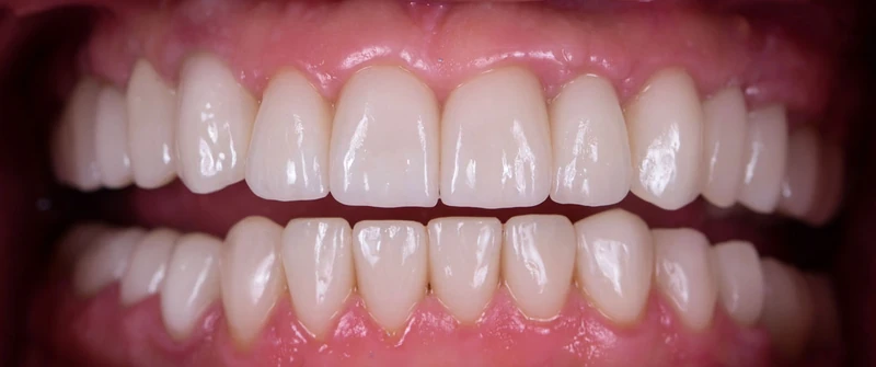 After smile restoration case 5: the same patient's teeth after treatment at Omni Dental