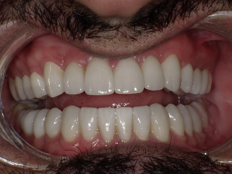 After smile restoration case 7: the same patient's teeth after treatment at Omni Dental