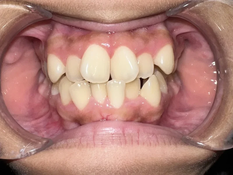Before smile restoration case 8: an Omni Dental patient's teeth before treatment