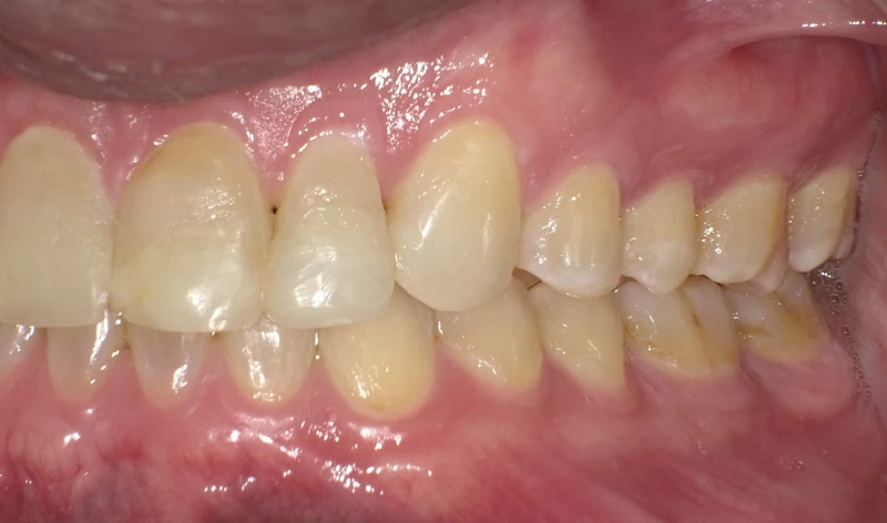 Before smile restoration (left side view): an Omni Dental patient's teeth before treatment