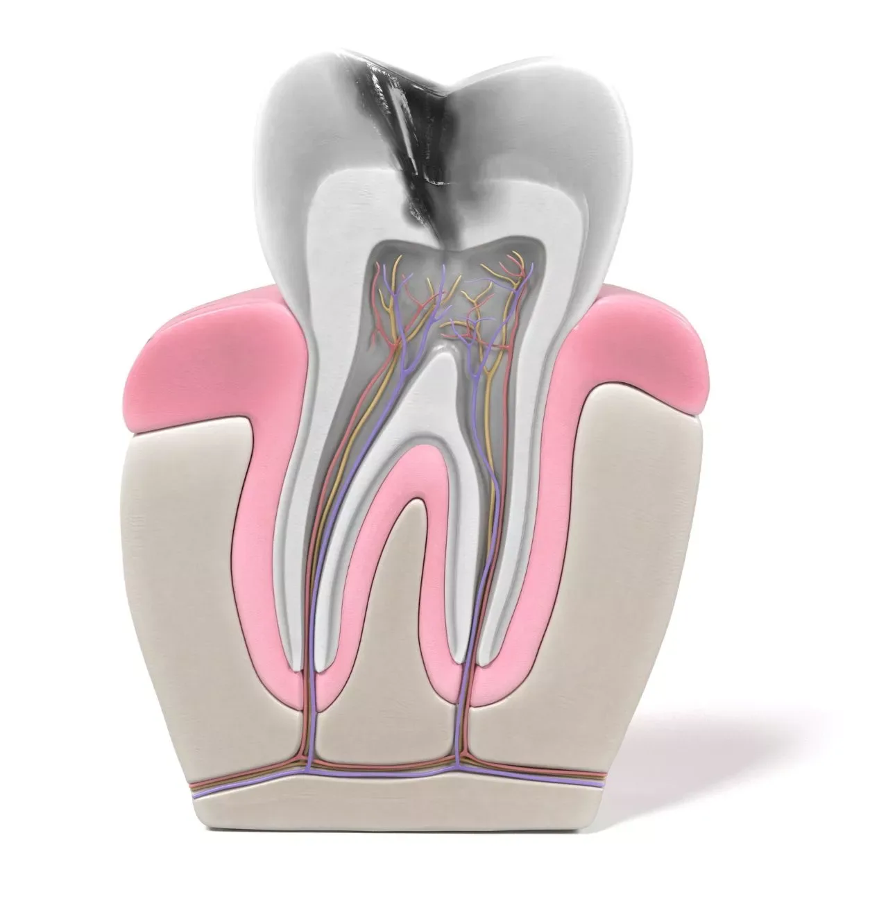 Benefits of Root Canal Therapy