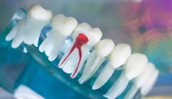 Why Choose Omni Dental for Your Root Canal Therapy
